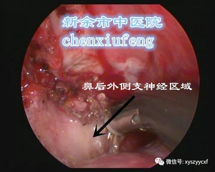 值得一提的是,我科针对"鼻粘膜高反应性鼻病"所开展的中药汤剂,针灸