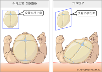 较真|头型会影响孩子的大脑发育吗?一文读懂"睡扁头"那些事