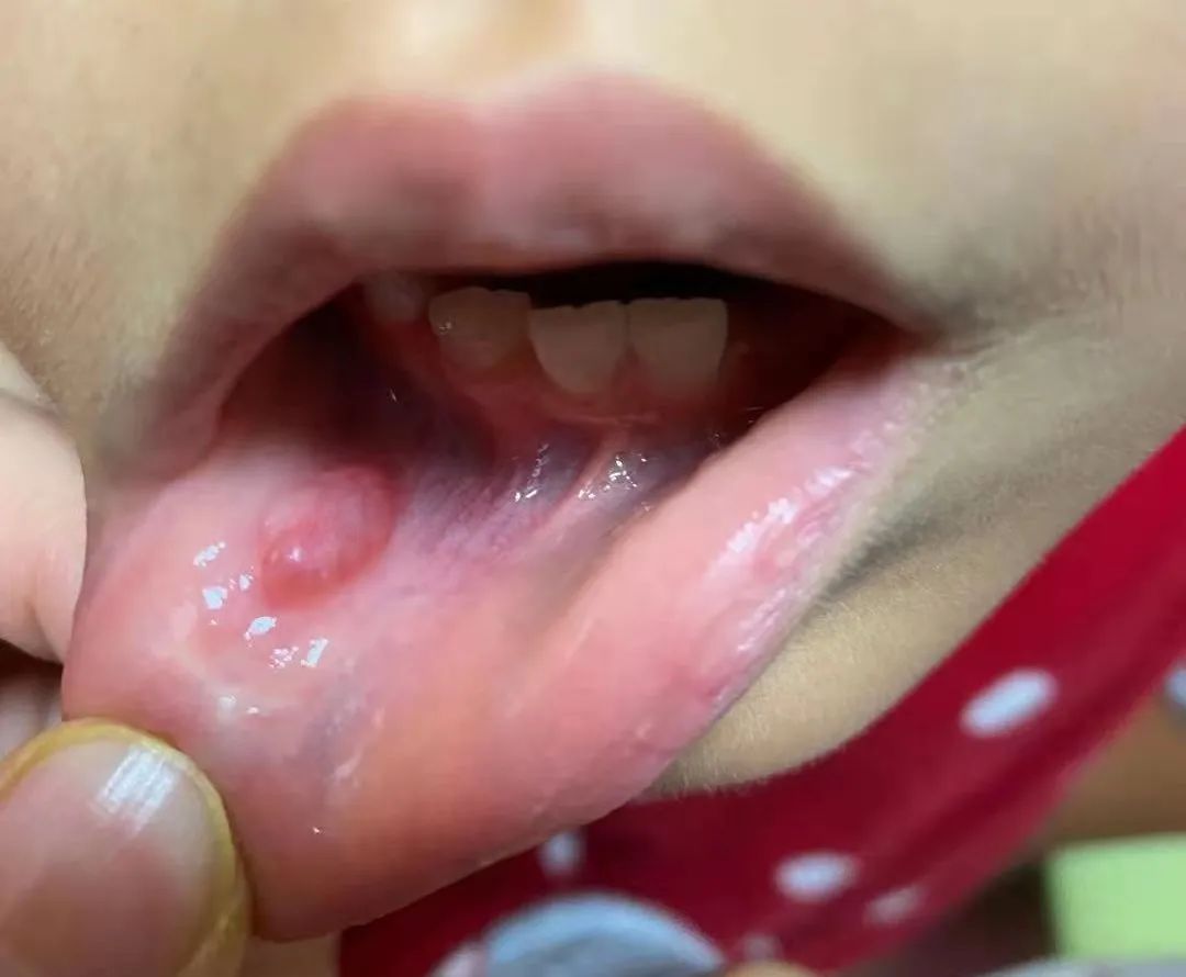 那这个"口腔黏液腺囊肿"是怎么形成的呢?