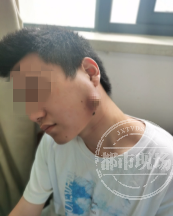 院口腔创伤整形科主治医师 王伟:经过检查发现,他是智齿引起的面颊瘘