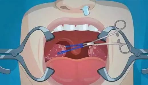 健康教育扁桃体总爱发炎怎样才能远离