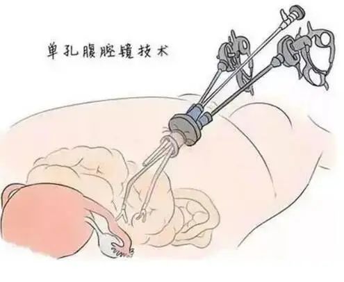 女人宫腔镜手术图图片