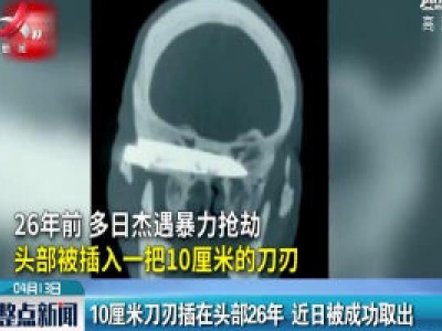 山东：10厘米刀刃插在头部26年 近日被成功取出