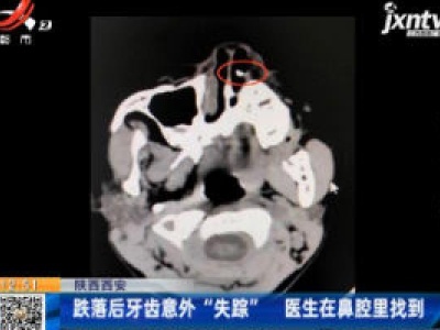 陕西西安：跌落后牙齿意外“失踪” 医生在鼻腔里找到