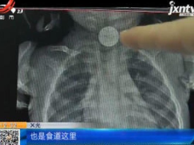湖南长沙：2岁女童误吞纽扣电池 食道灼伤紧急手术
