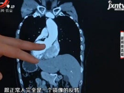 南昌：“镜面人”内脏反位 手术也得反着做