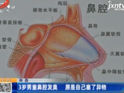 南昌：3岁男童鼻腔发臭 原是自己塞了异物