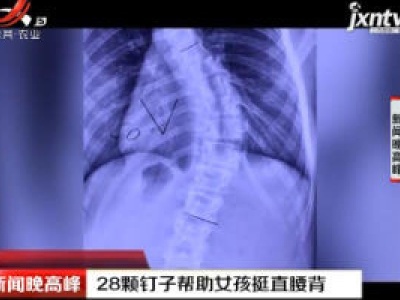 陕西：28颗钉子帮助女孩挺直腰背