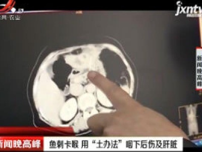 桂林：鱼刺卡喉 用“土办法”咽下后伤及肝脏