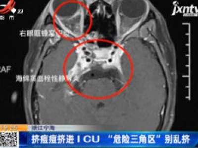 浙江宁海：挤痘痘挤进ICU “危险三角区”别乱挤