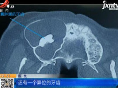 陕西西安：男子面部肿痛难忍 竟是鼻窦里长牙惹的祸