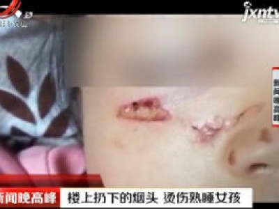 楼上扔下的烟头 烫伤熟睡女孩