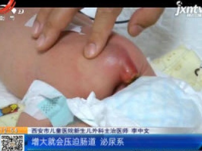 陕西西安：怀胎六月肚里宝宝长“尾巴” 妈妈决心生下再手术