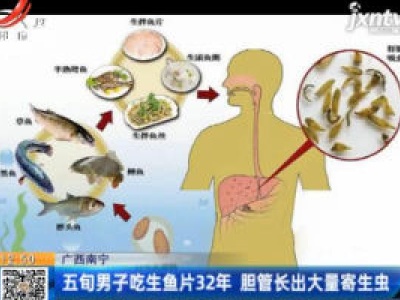 广西南宁：五旬男子吃生鱼片32年 胆管长出大量寄生虫 
