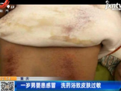 重庆：一岁男婴患感冒 洗药浴致皮肤过敏