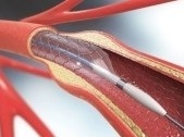 降幅93%，便宜1万多元 揭秘冠脉支架降价背后的秘密