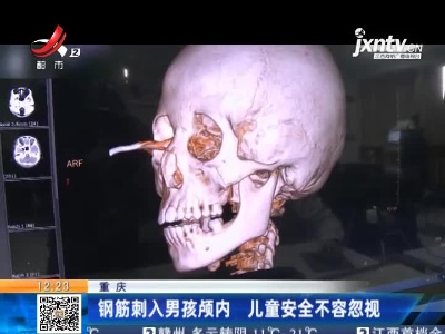 重庆：钢筋刺入男孩颅内 儿童安全不容忽视