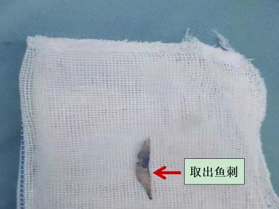 祸从口入！一根鱼刺引发一桩致命“悬案”