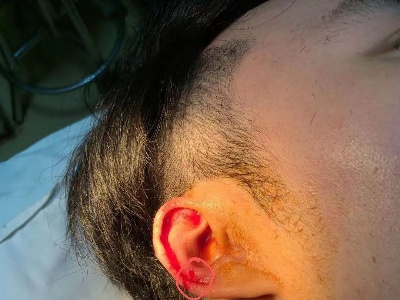 疼！南昌一男子耳朵被剪，缝了4针