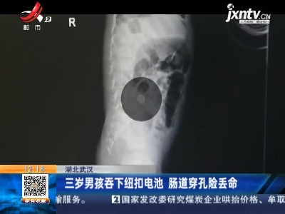 湖北武汉：三岁男孩吞下纽扣电池 肠道穿孔险丢命