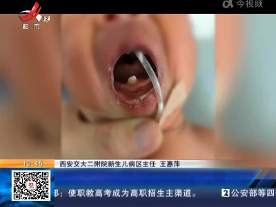陕西西安：罕见！新生宝宝长牙 60小时后自动脱落