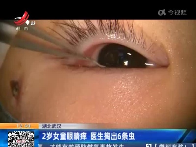 湖北武汉：2岁女童眼睛痒 医生掏出6条虫