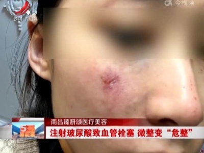 南昌臻妍颂医疗美容：注射玻尿酸致血管栓塞 微整变“危整”