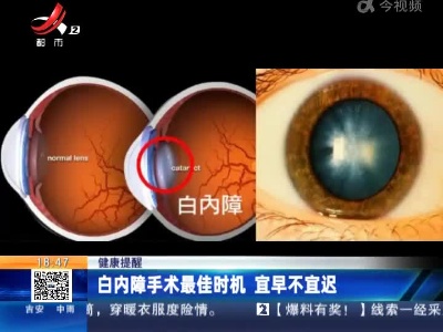 健康提醒：白内障手术最佳时机 宜早不宜迟