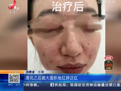 【都市消费调查】南昌经开：花一万五在“痘医生”祛痘 消费者称“没有一点效果”