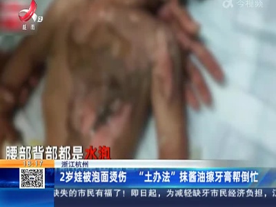 浙江杭州：2岁娃被泡面烫伤 “土办法”抹酱油擦牙膏帮倒忙