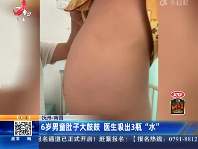 抚州—南昌：6岁男童肚子大鼓鼓 医生吸出3瓶“水”