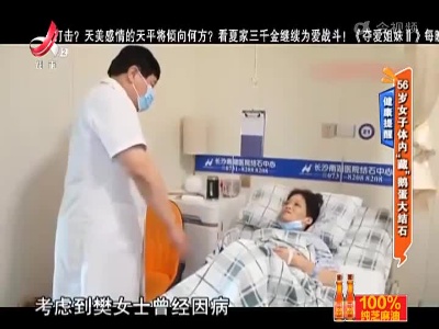 健康提醒——56岁女子体内“藏”鹅蛋大结石