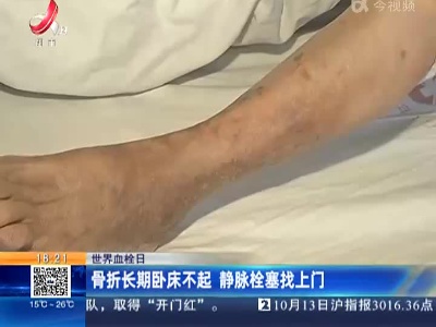 【世界血栓日】骨折长期卧床不起 静脉栓塞找上门