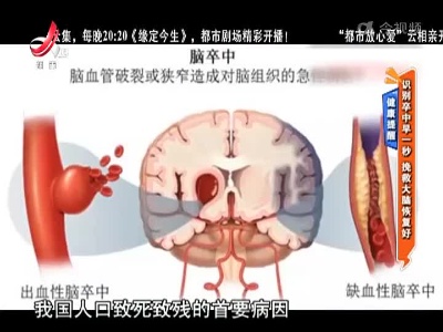 健康提醒——识别卒中早一秒 挽救大脑恢复好