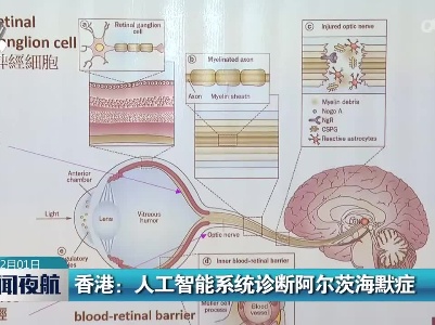 香港：人工智能系统诊断阿尔茨海默症