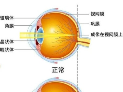 暑假摘镜“泰裤辣”，全飞秒适合我吗？