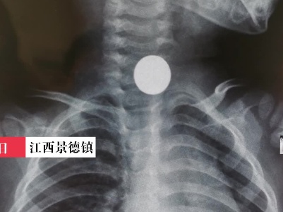 江西景德镇：惊险！2岁儿童误吞硬币卡喉
