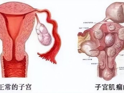 江西省妇幼保健院成功为患者切除巨大宫颈肌瘤 重达5斤接近排球大小