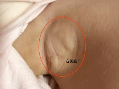 一岁女童在家中被水银体温计插入腋下