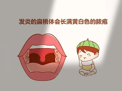 江西省儿童医院：扁桃体化脓了，一定要用抗菌药吗？