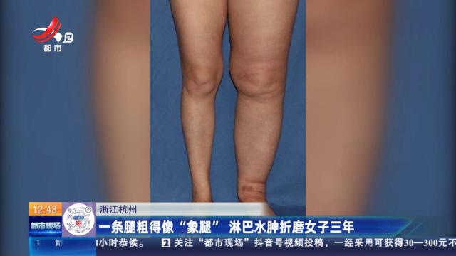 浙江杭州：一条腿粗得像“象腿” 淋巴水肿折磨女子三年