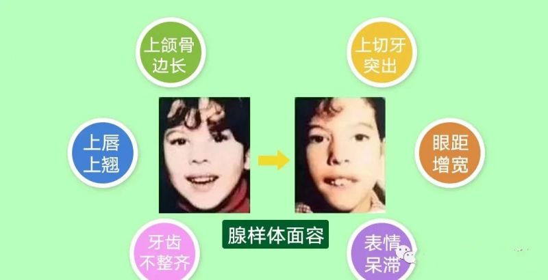 江西省儿童医院：儿童的扁桃体、腺样体到底切不切？来听听耳鼻咽喉科医生的讲解...