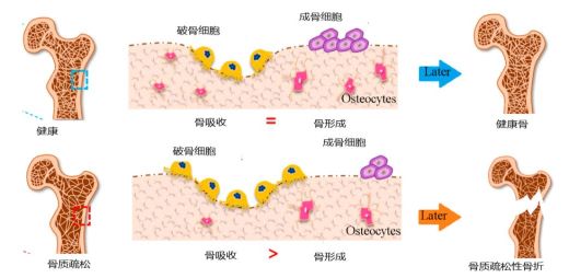 骨质疏松症防治的新利器——宜春学院第一附属医院 万载县人民医院开展骨转换标志物（简称BTMs）检测