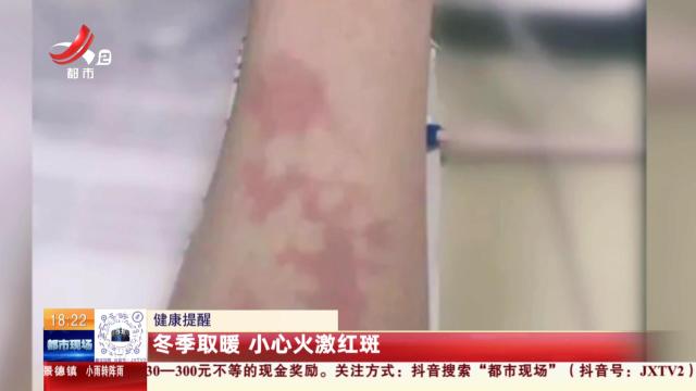 健康提醒：冬季取暖 小心火激红斑