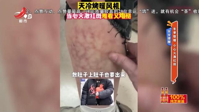 安全提醒——冬季取暖 小心火激红斑