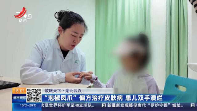 【放眼天下】湖北武汉：“泡椒凤爪”偏方治疗皮肤病 患儿双手溃烂