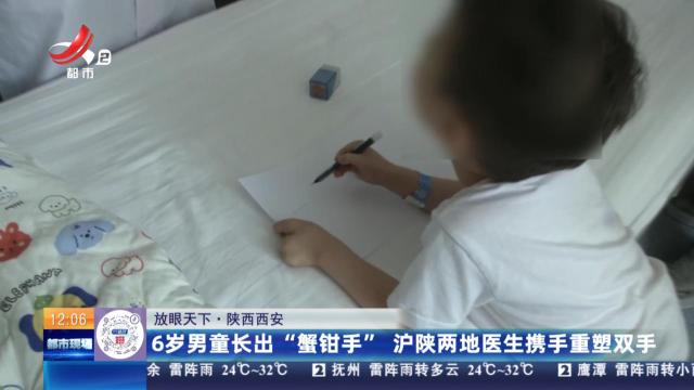 【放眼天下】陕西西安：6岁男童长出“蟹钳手” 沪陕两地医生携手重塑双手
