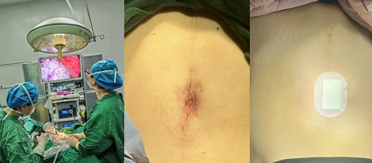 单孔腹腔镜破解盆腔巨大囊肿难题，微创技术守护女性健康之美