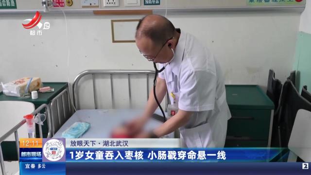 【放眼天下】湖北武汉：1岁女童吞入枣核 小肠戳穿命悬一线