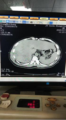 一针探癌！高安市中医院为患者成功实施CT引导下经皮肝穿刺活检术
